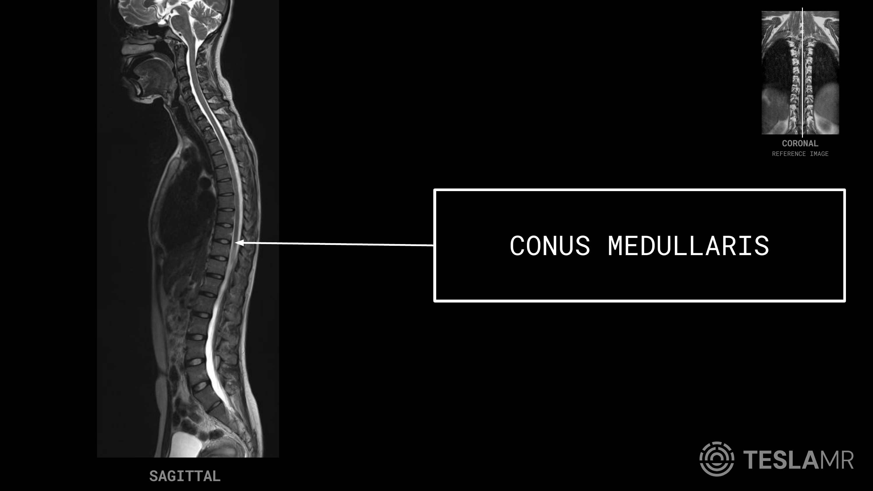 Conus Medullaris labeled on a T-Spine MRI (Sagittal)