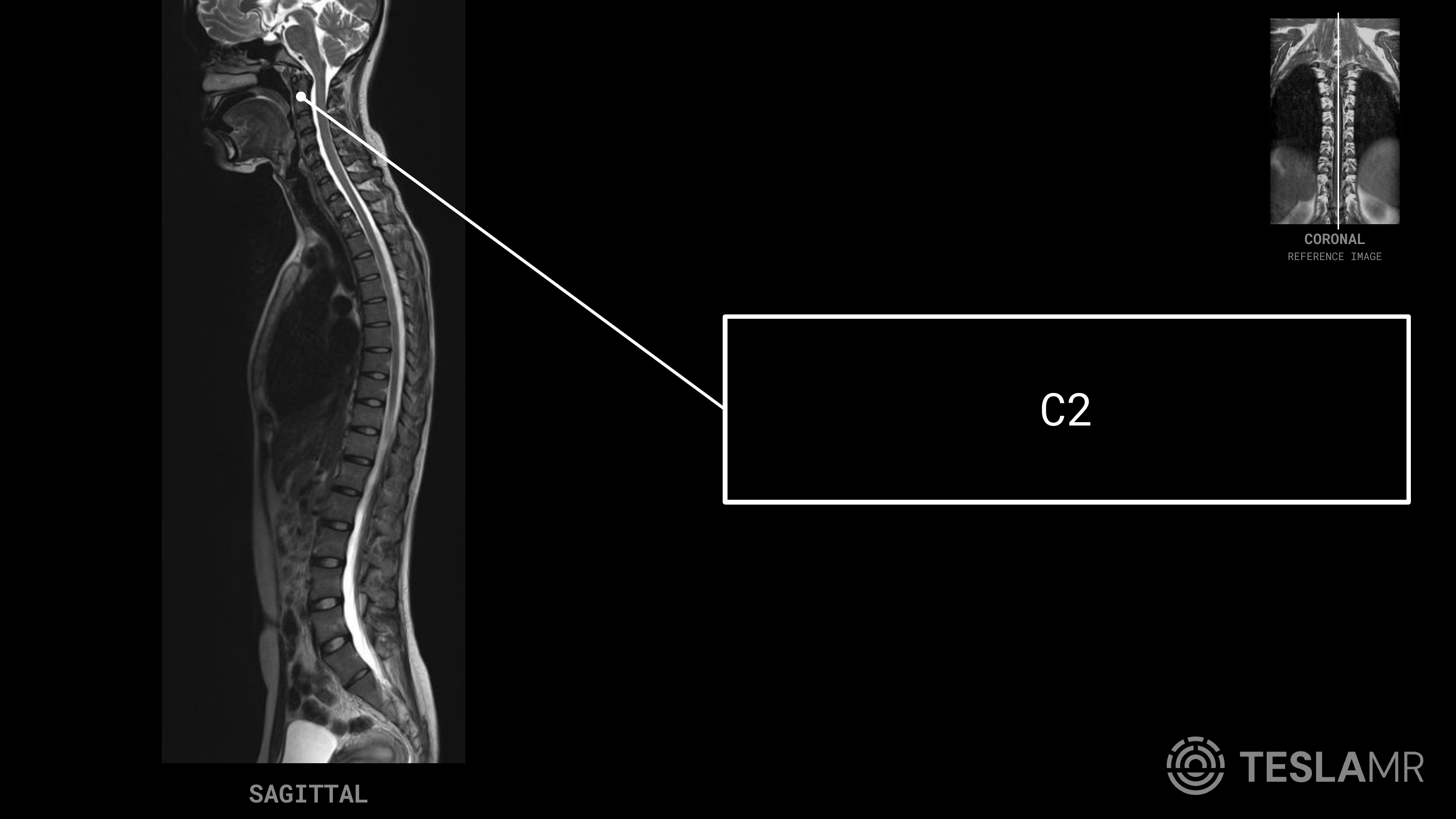 C2 labeled on a T-Spine MRI (Sagittal)