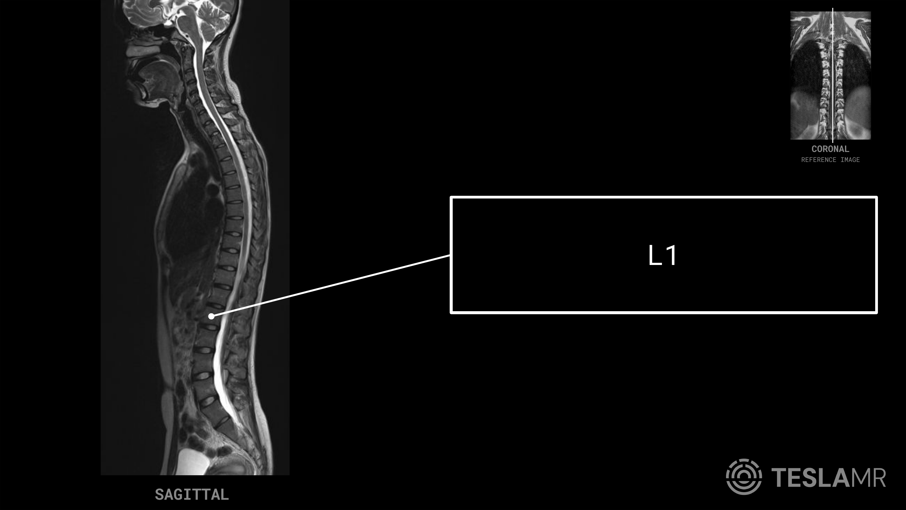 L1 labeled on a T-Spine MRI (Sagittal)
