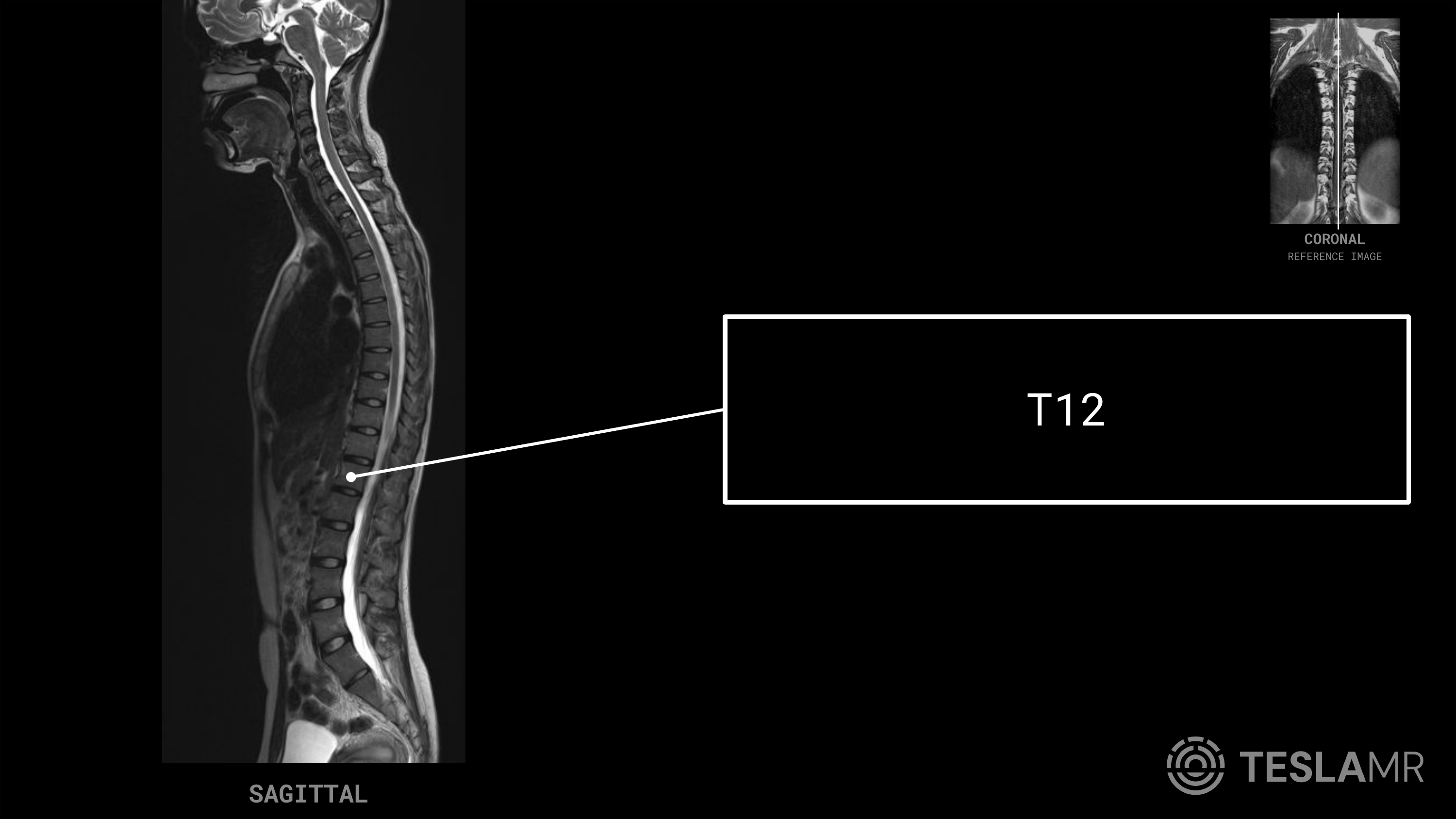 T12 labeled on a T-Spine MRI (Sagittal)