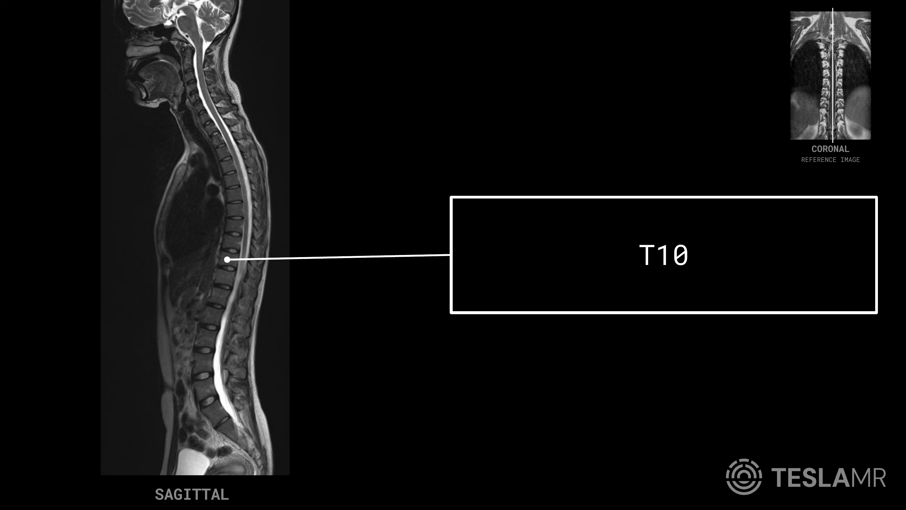 T10 labeled on a T-Spine MRI (Sagittal)