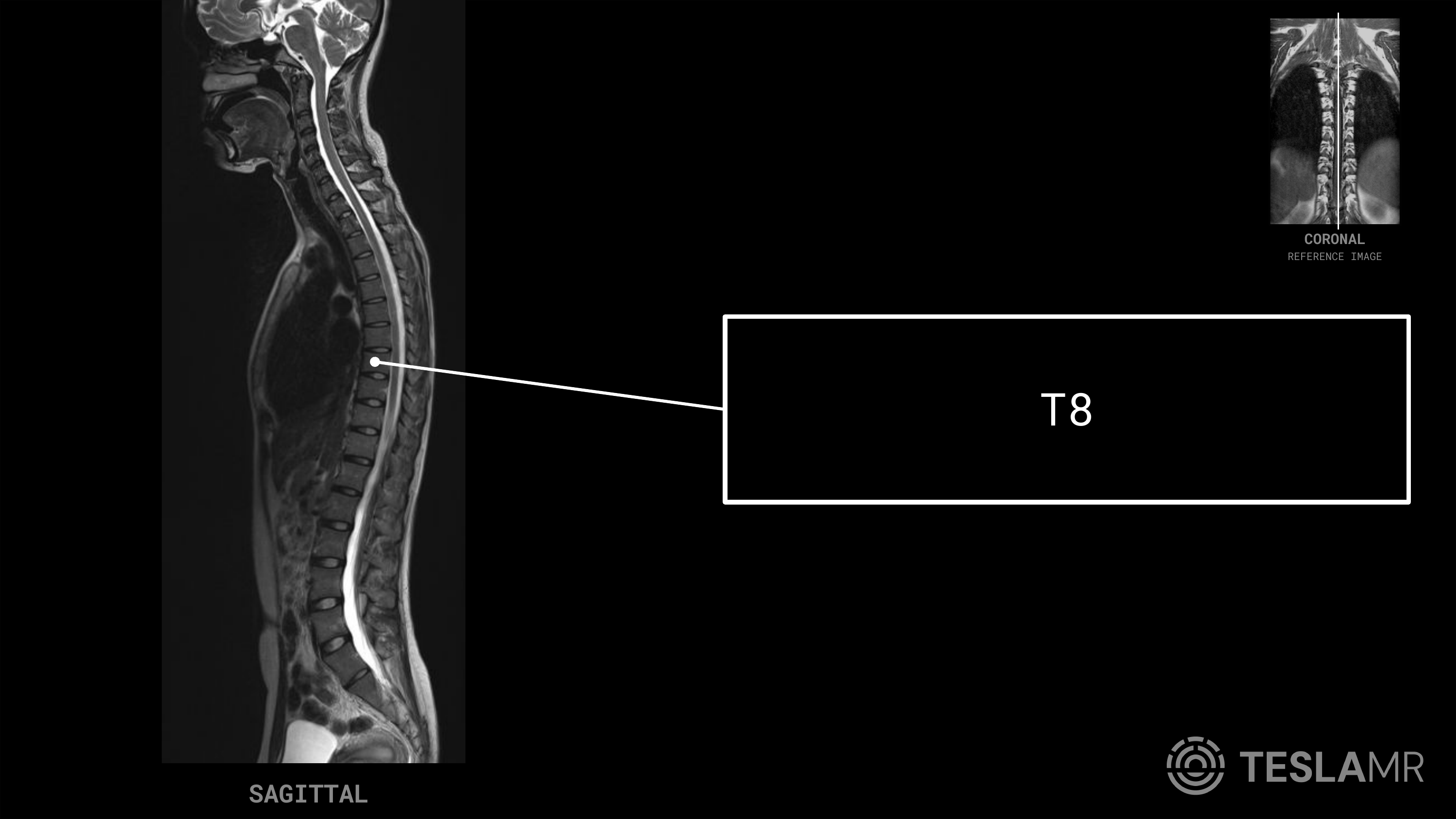 T8 labeled on a T-Spine MRI (Sagittal)