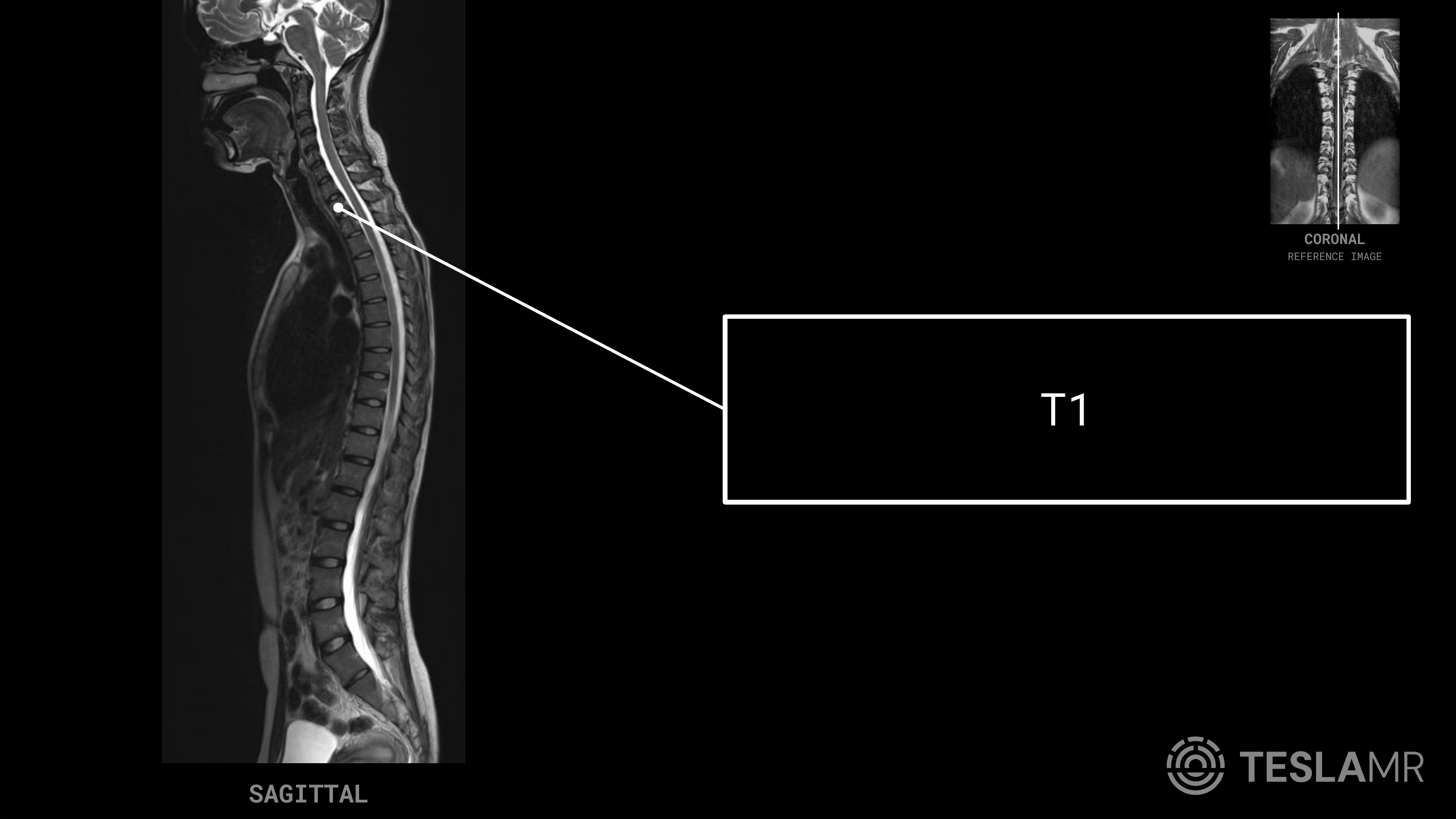 T1 labeled on a T-Spine MRI (Sagittal)