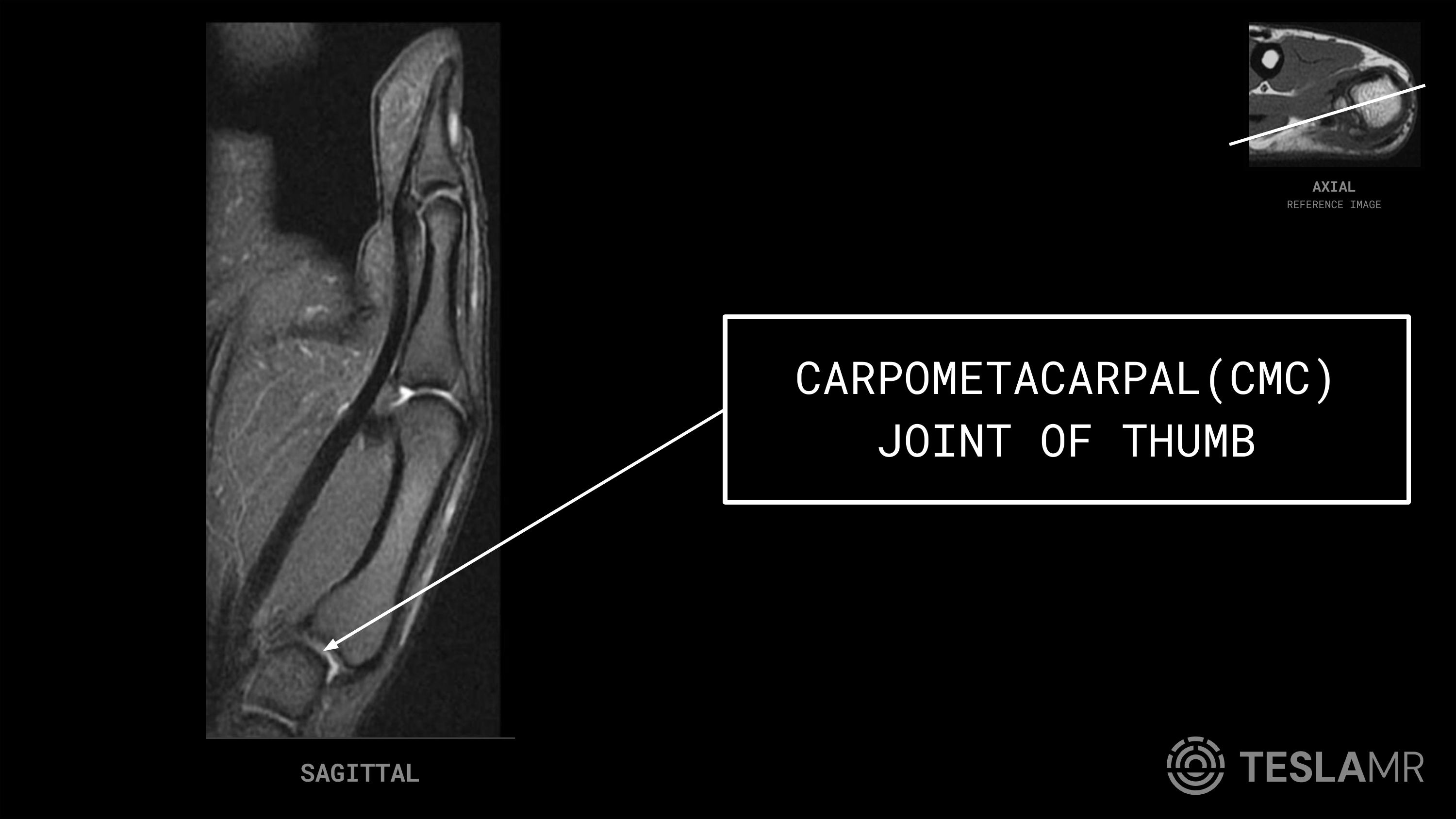 Carpometacarpal (CMC) Joint of Thumb labeled on a Thumb MRI (Sagittal)