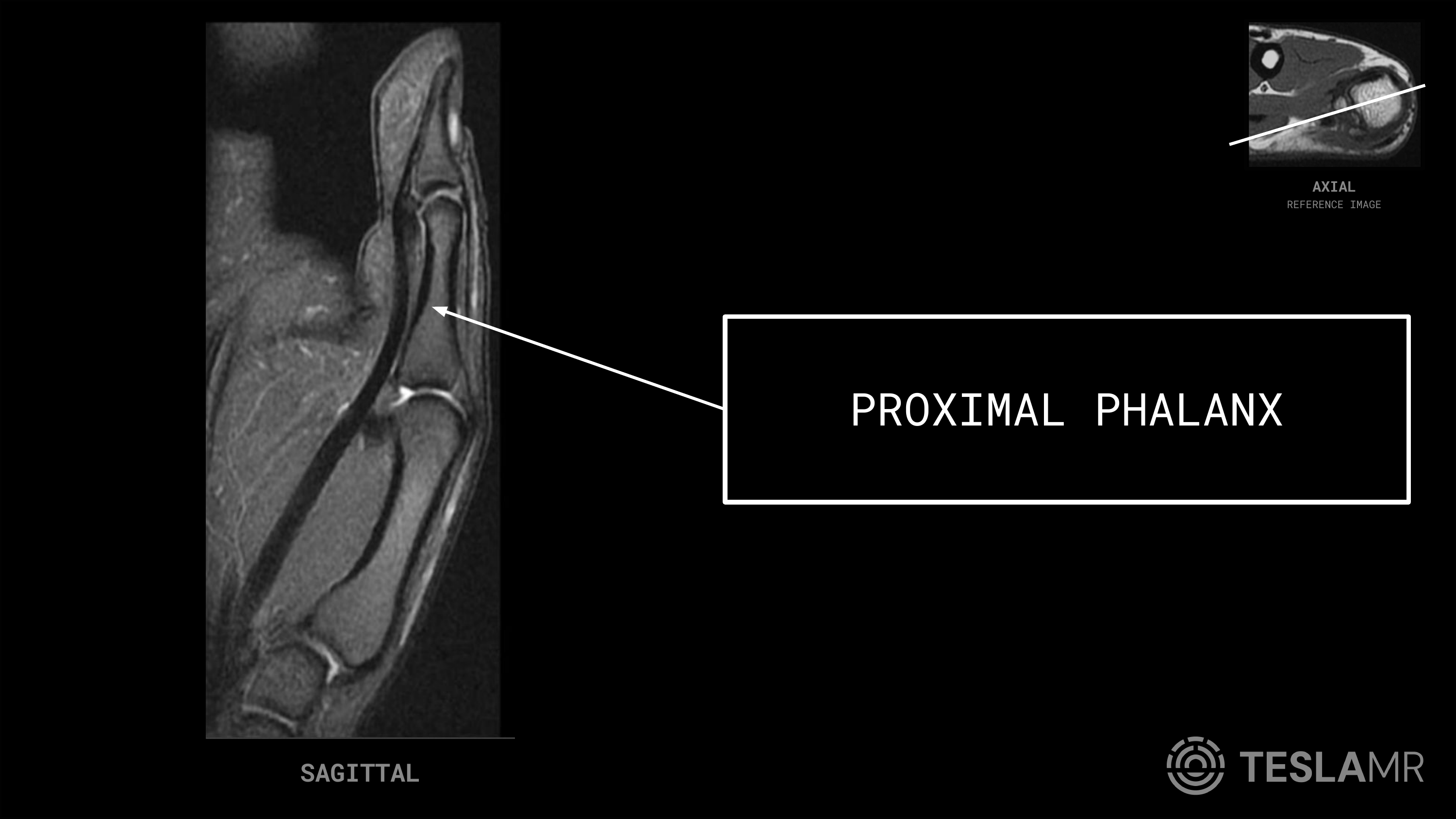 Proximal Phalanx labeled on a Thumb MRI (Sagittal · Coronal)