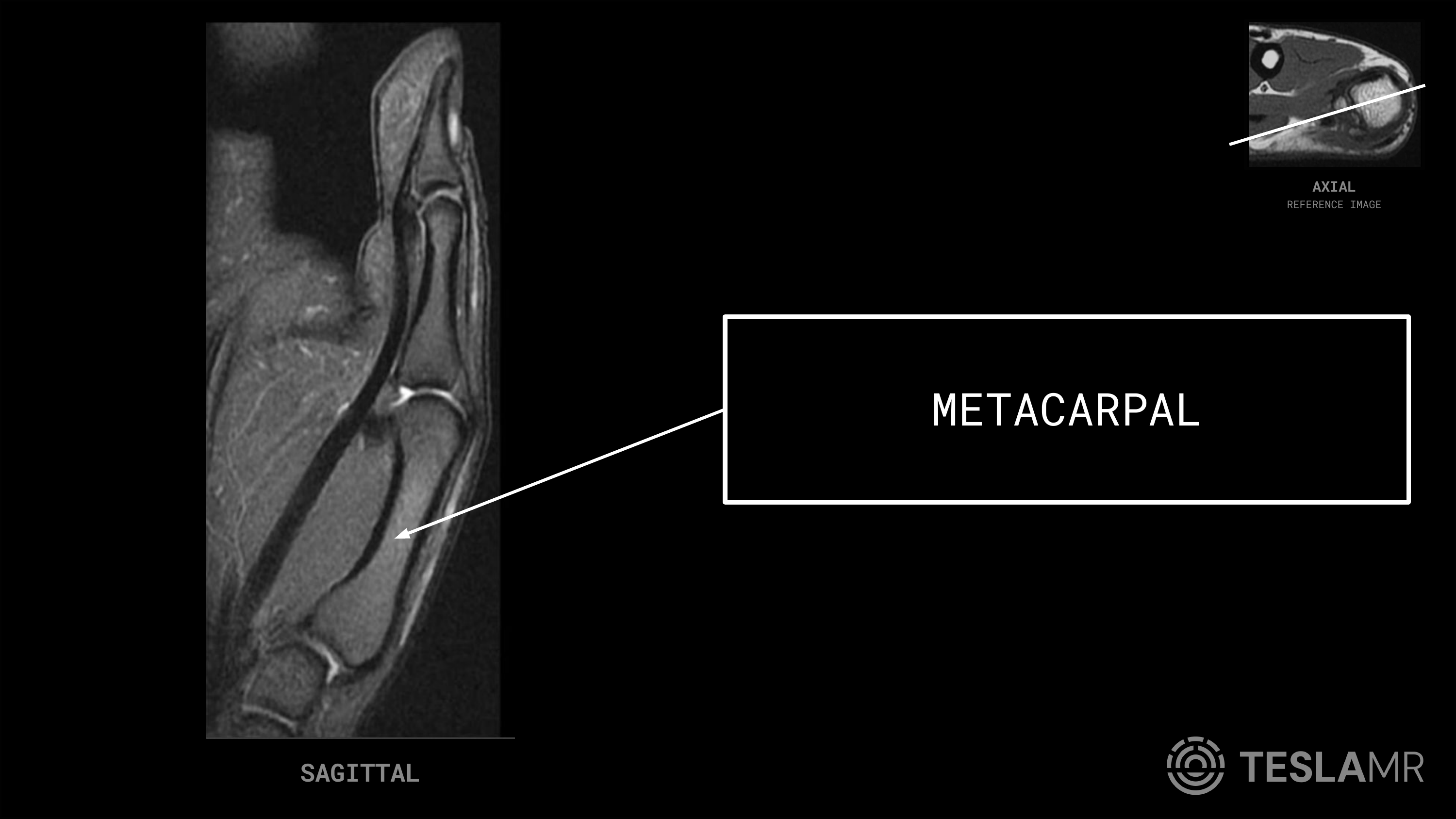 Metacarpal labeled on a Thumb MRI (Sagittal · Coronal)