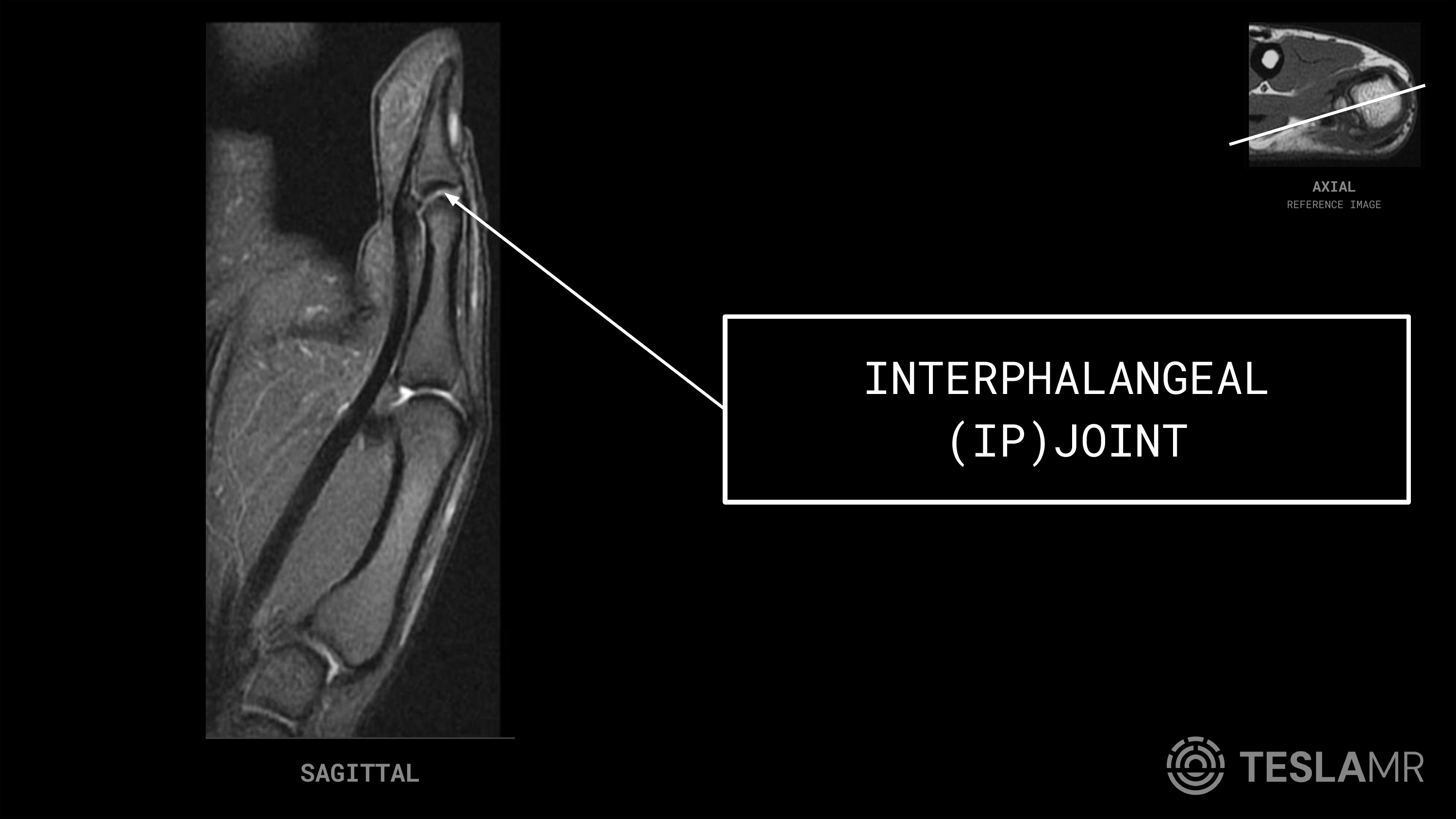 Interphalangeal (IP) Joint labeled on a Thumb MRI (Sagittal)