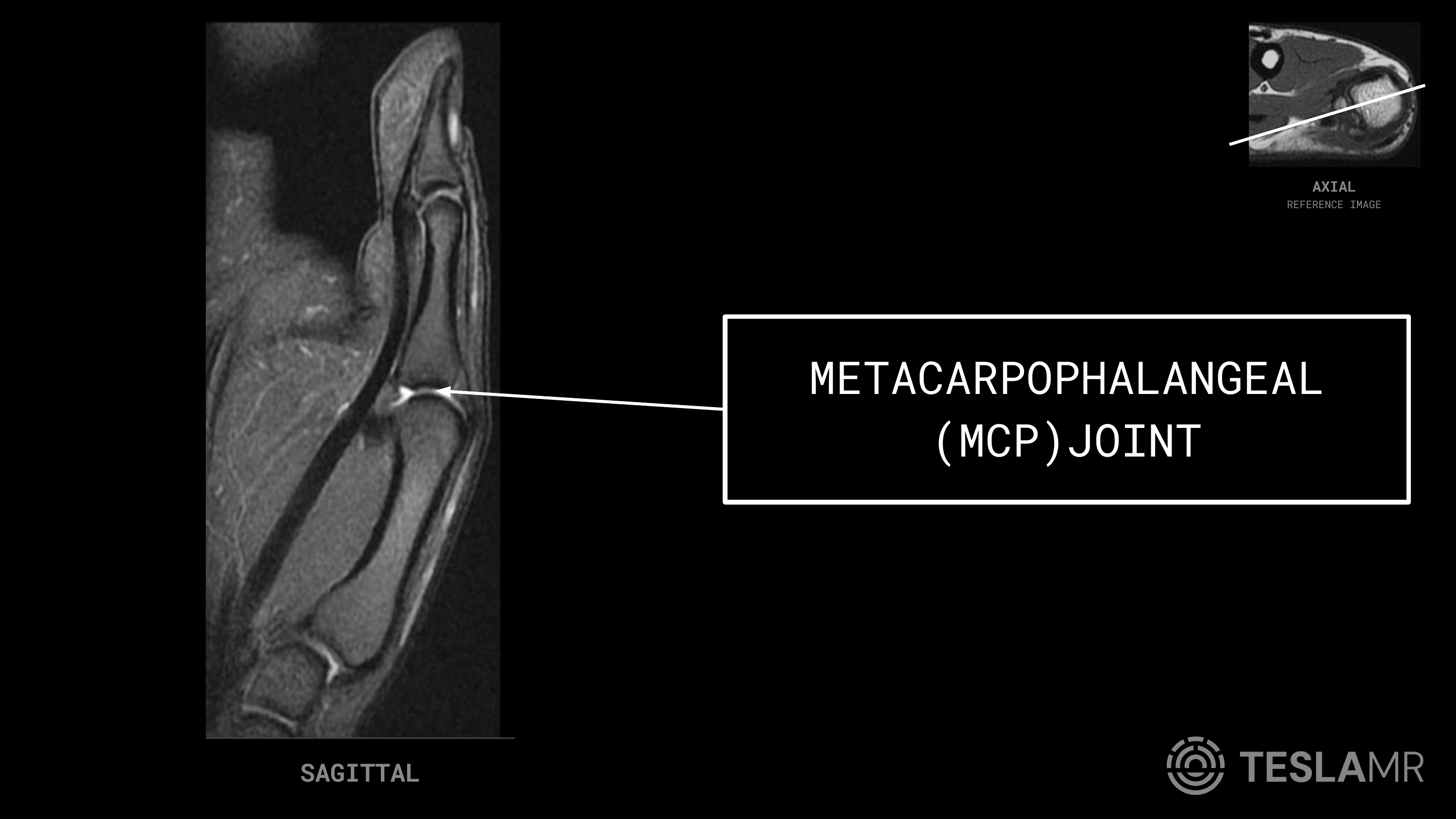 Metacarpophalangeal (MCP) Joint labeled on a Thumb MRI (Sagittal · Coronal)