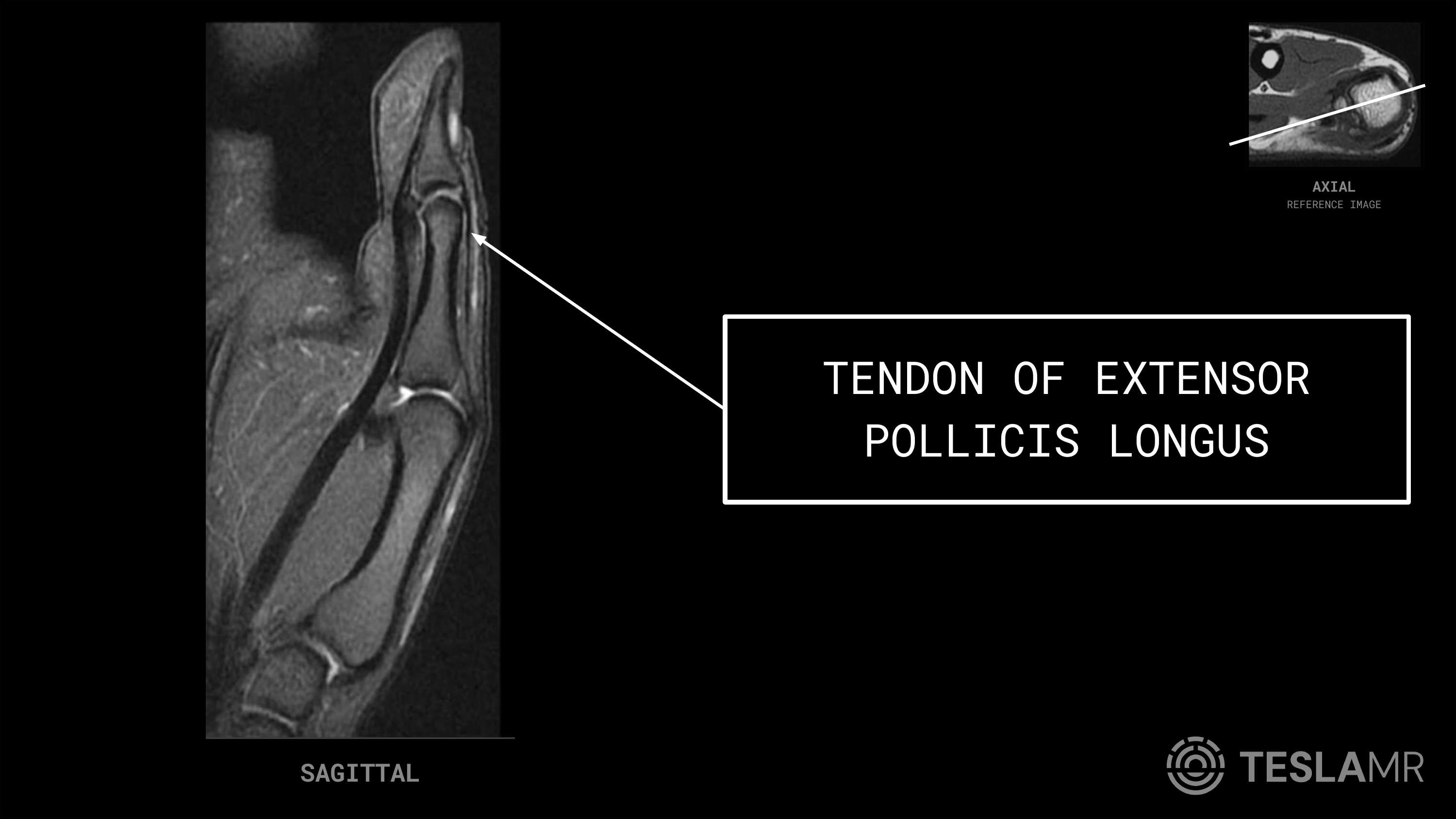 Tendon of Extensor Pollicis Longus labeled on a Thumb MRI (Sagittal)