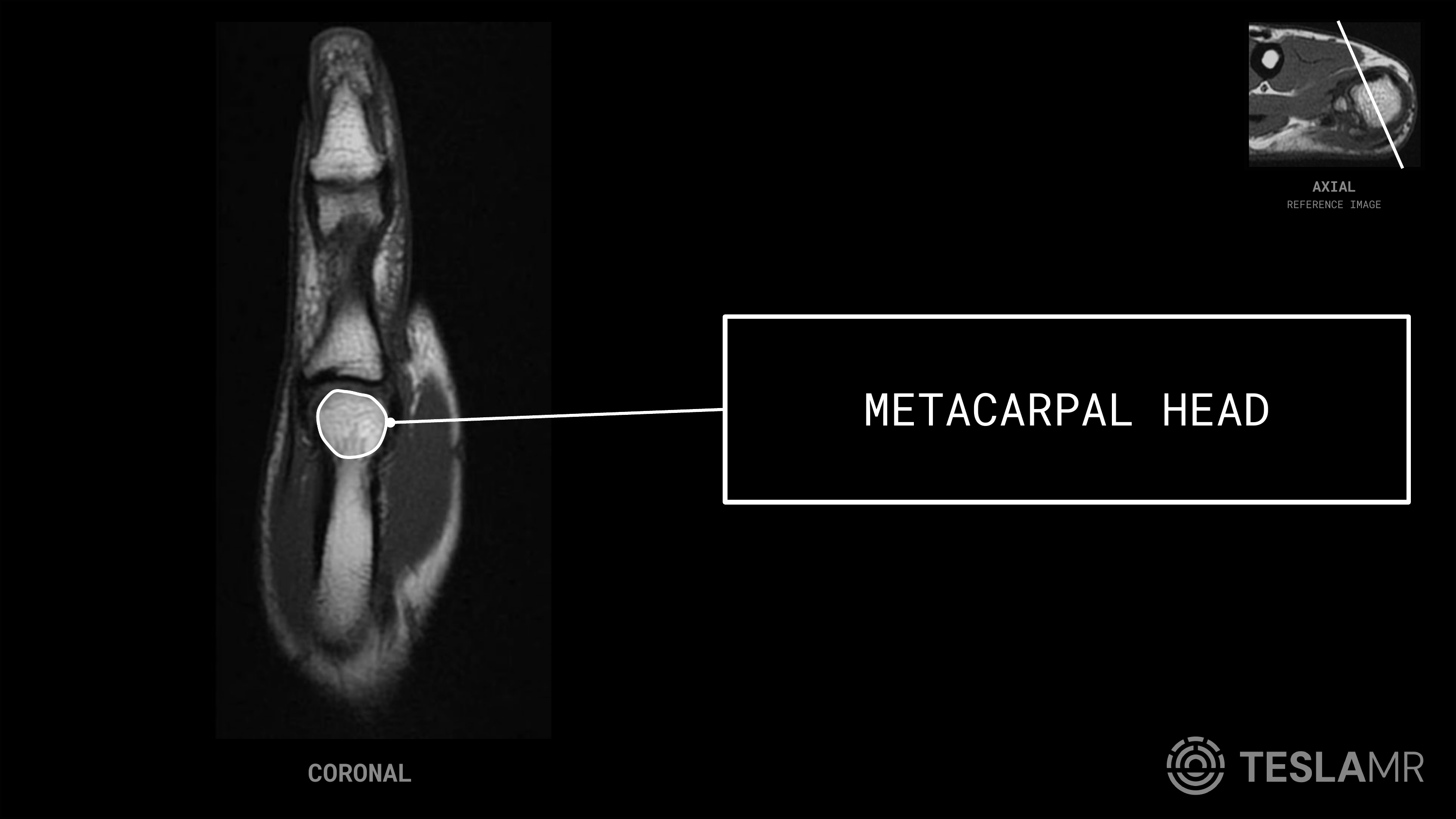 Metacarpal Head labeled on a Thumb MRI (Coronal)