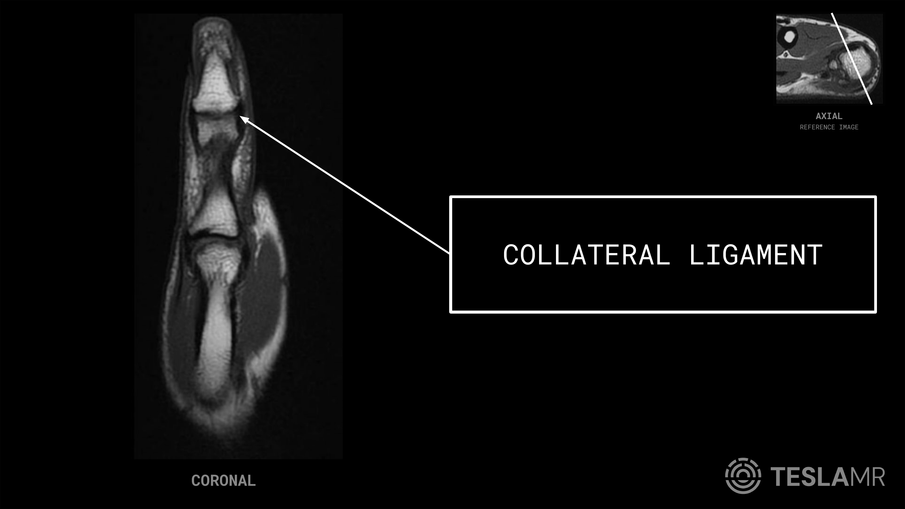 Collateral Ligament labeled on a Thumb MRI (Coronal)
