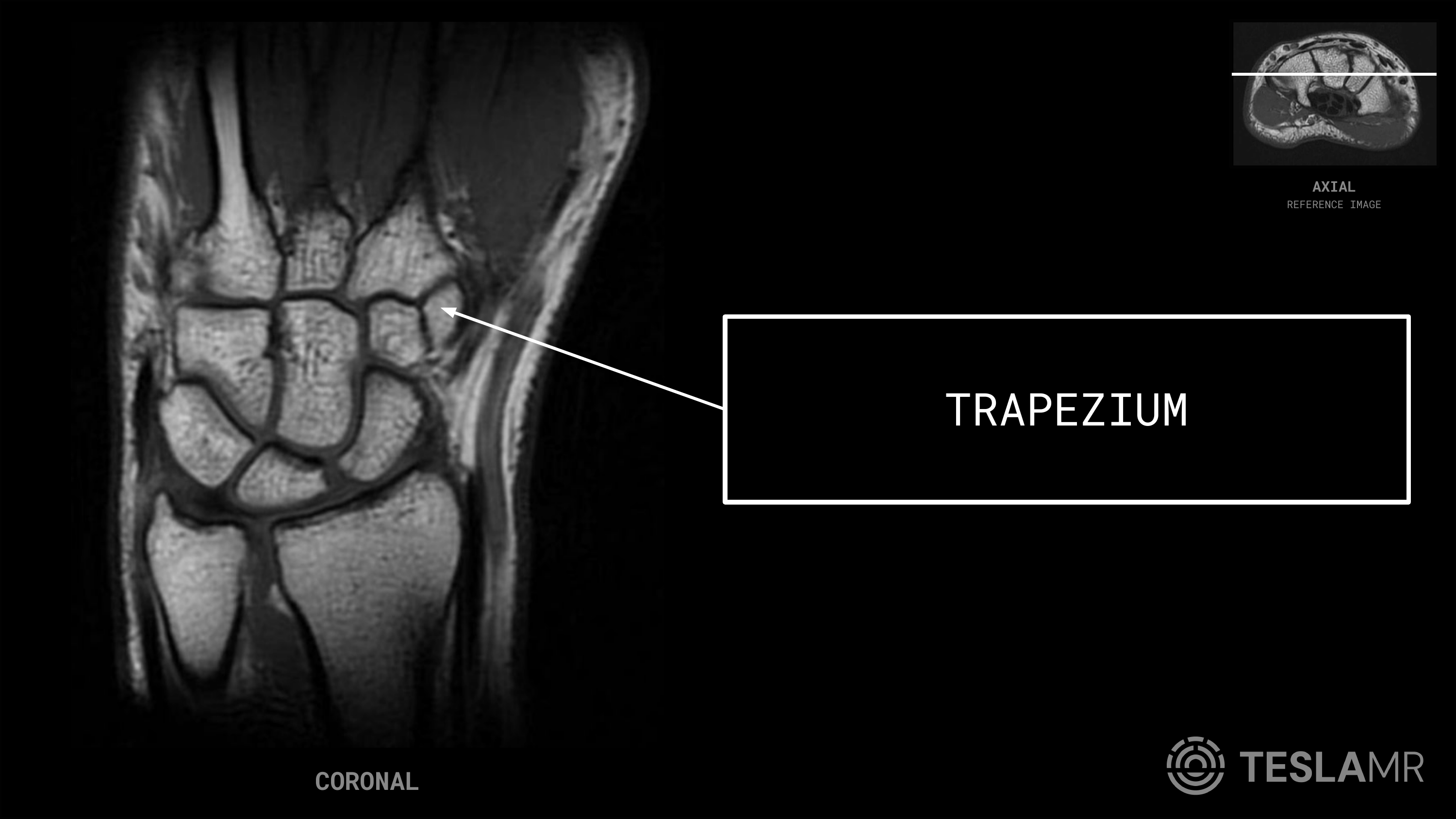 Trapezium labeled on a Wrist MRI (Coronal · Axial)