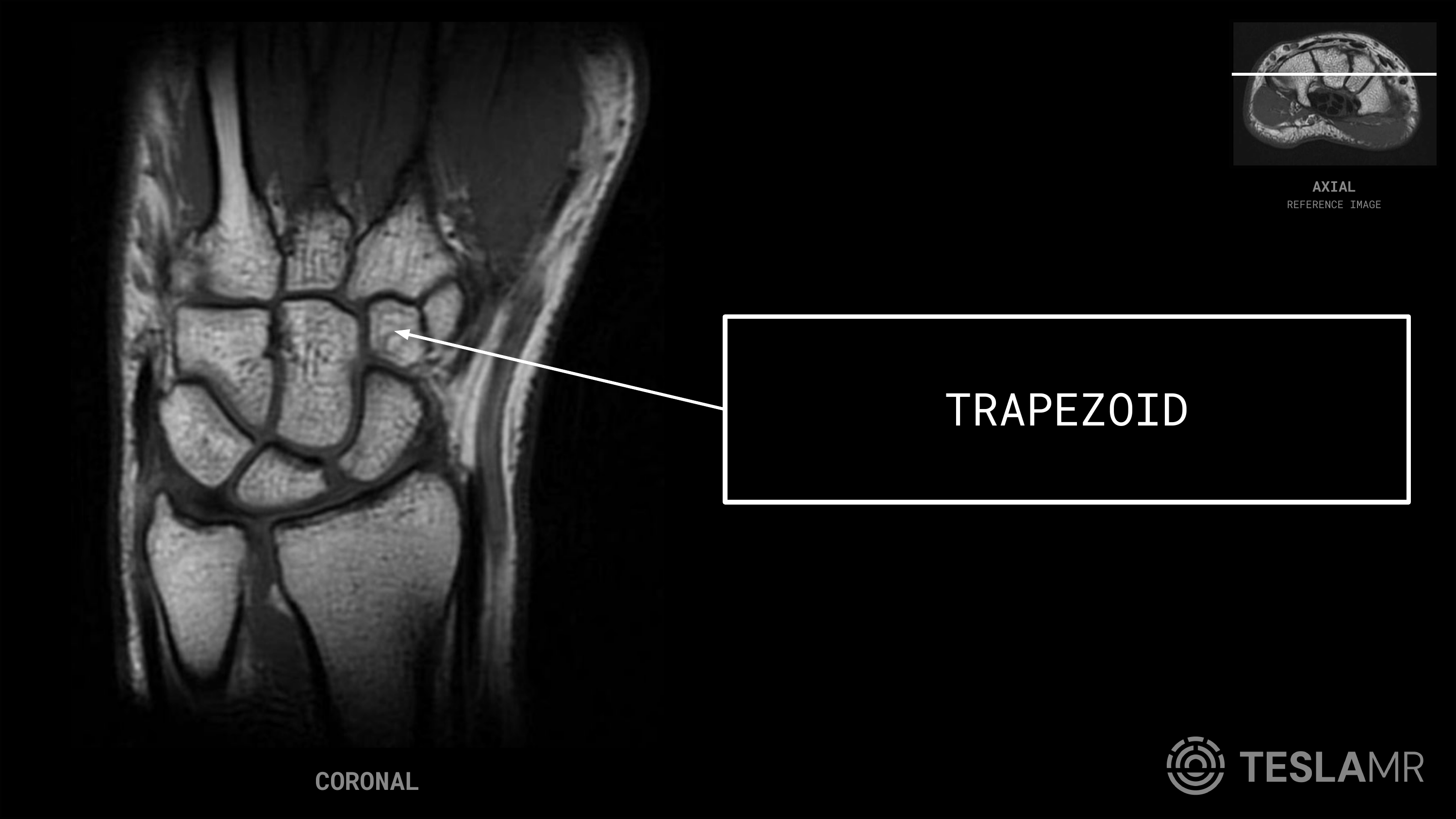 Trapezoid labeled on a Wrist MRI (Coronal · Axial)