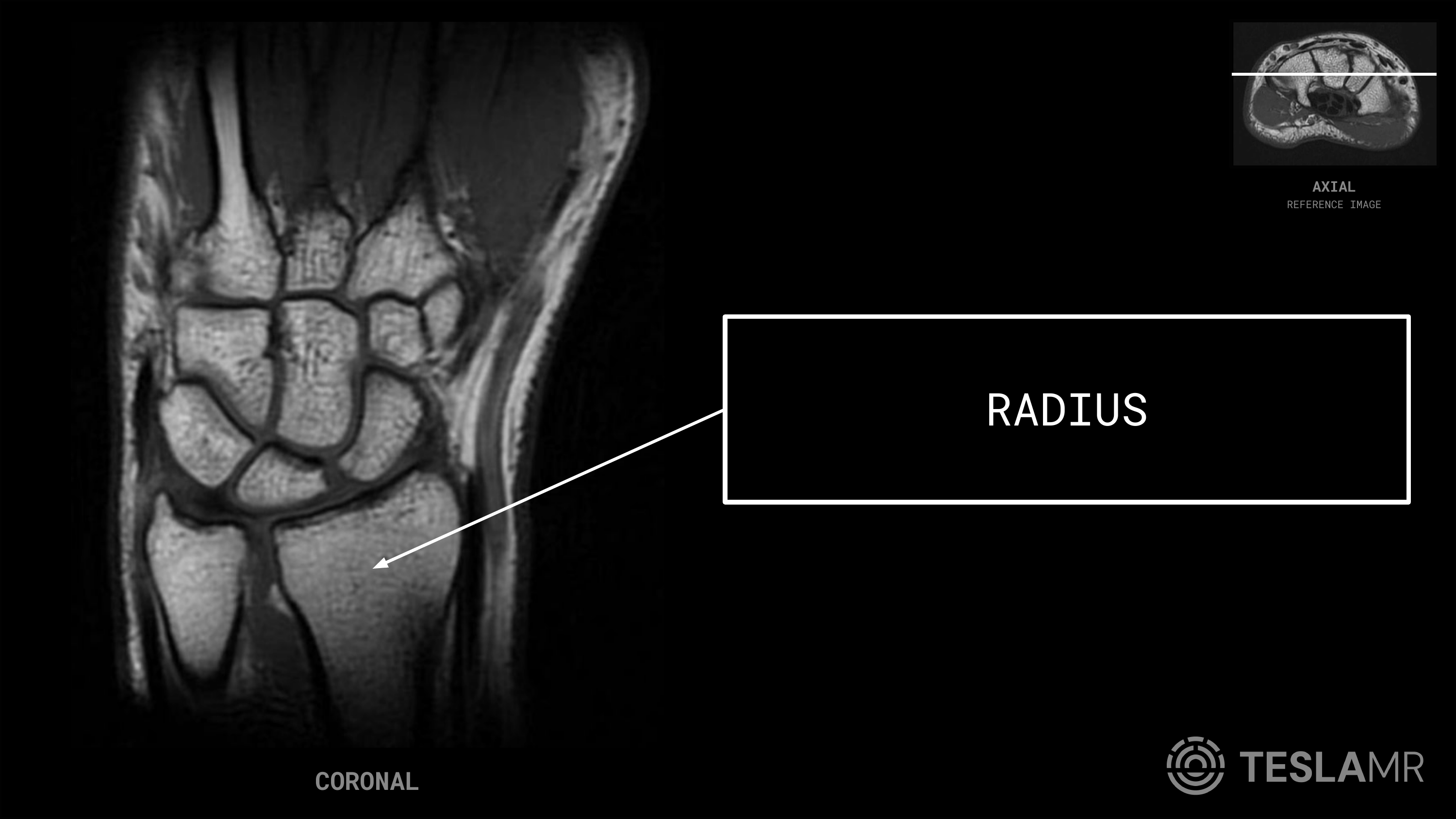 Radius labeled on a Wrist MRI (Coronal)