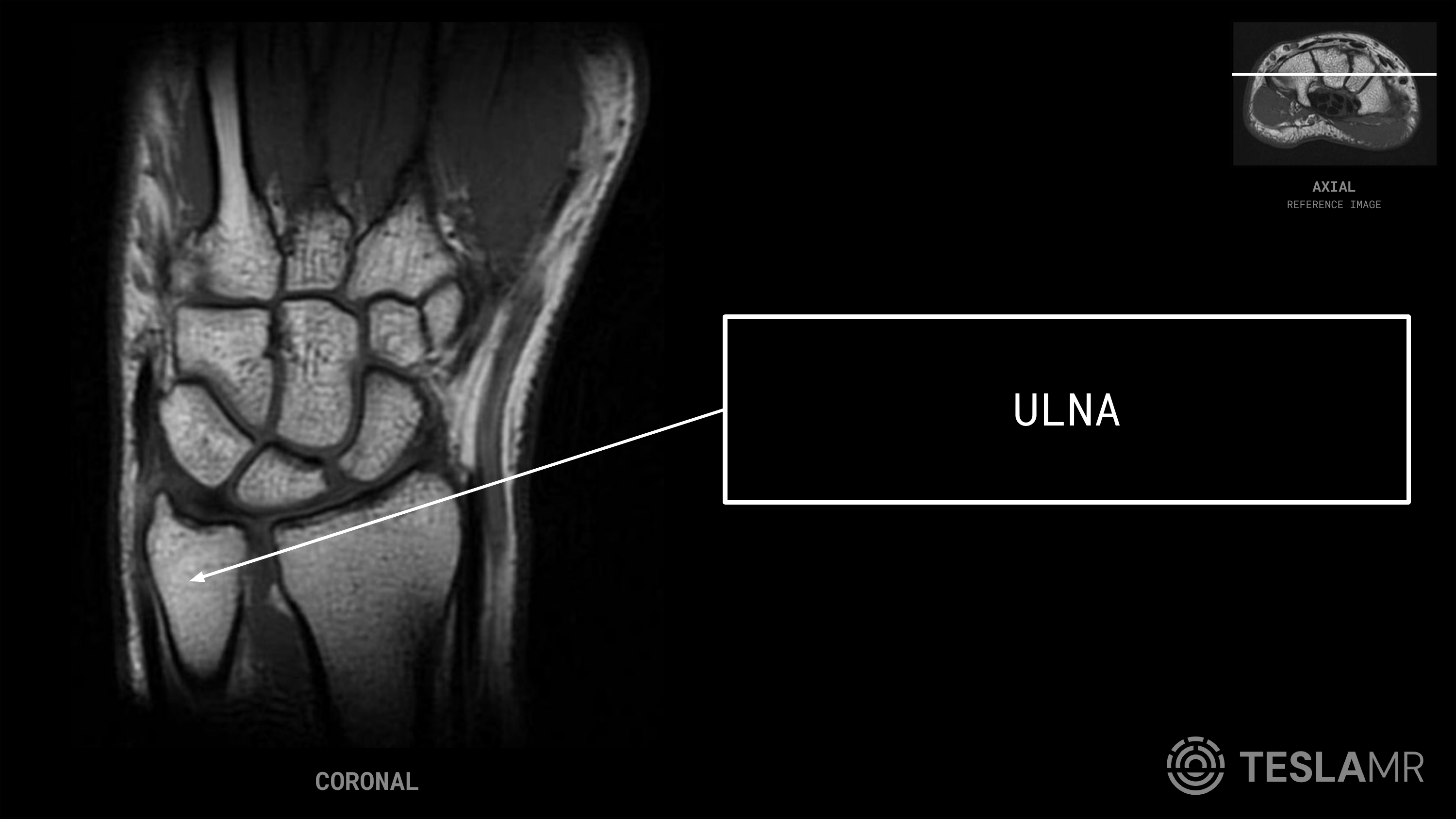Ulna labeled on a Wrist MRI (Coronal)