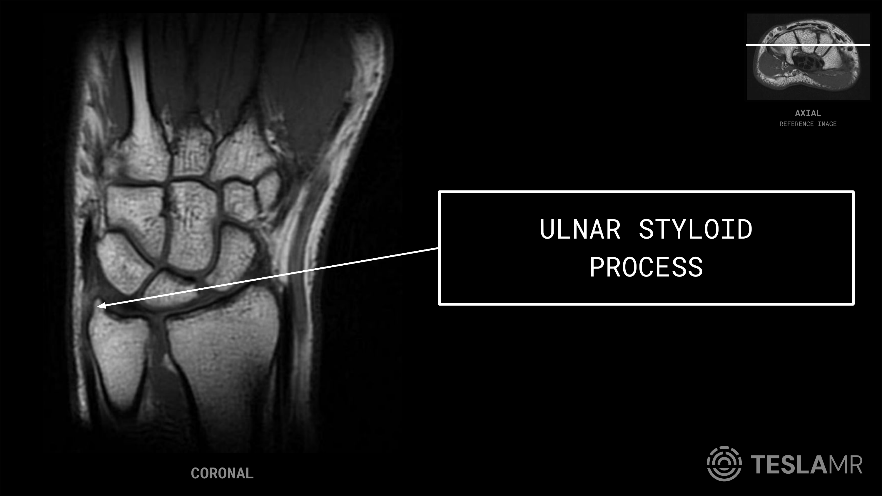 Ulnar Styloid Process labeled on a Wrist MRI (Coronal)
