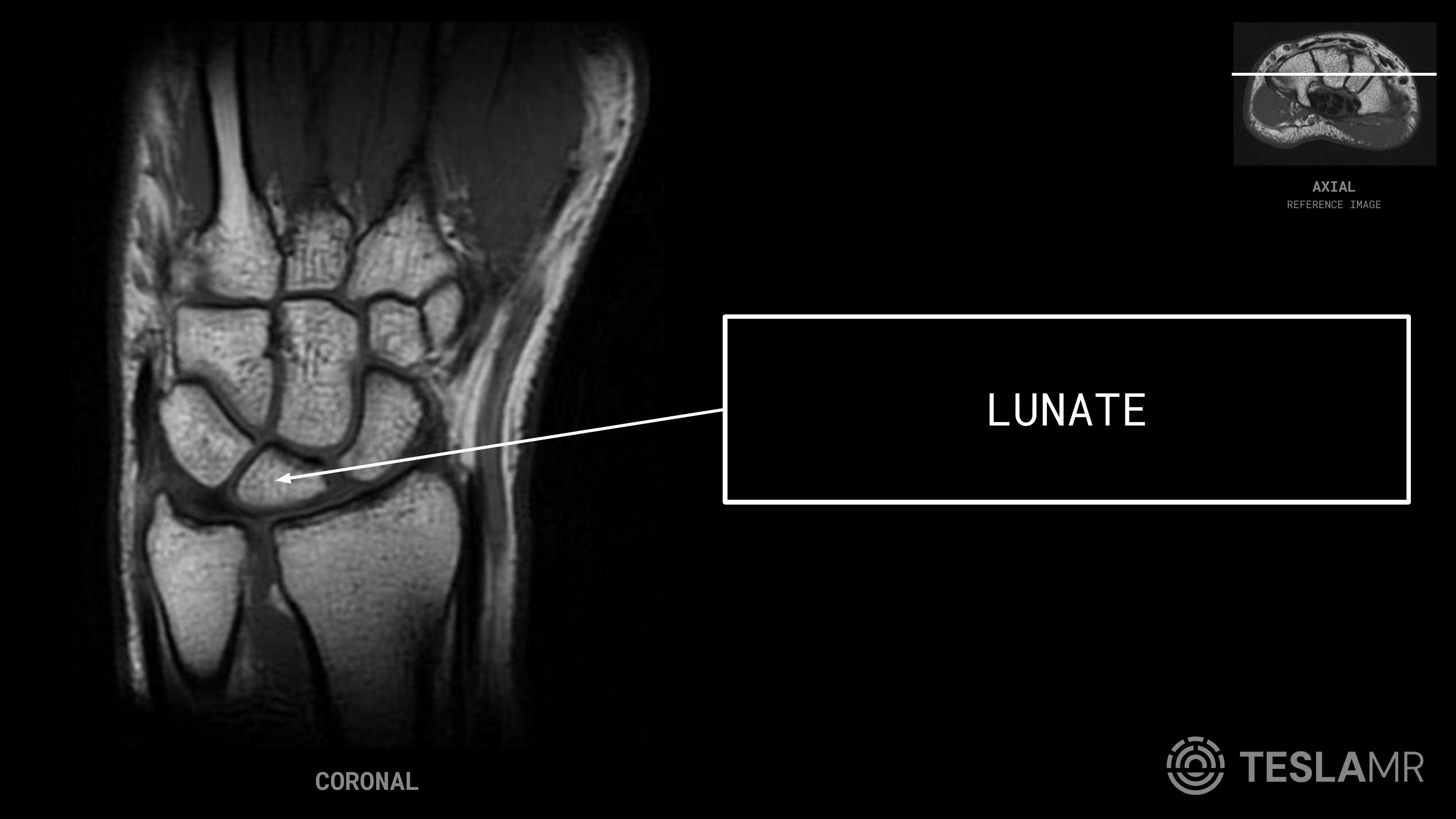Lunate labeled on a Wrist MRI (Coronal)