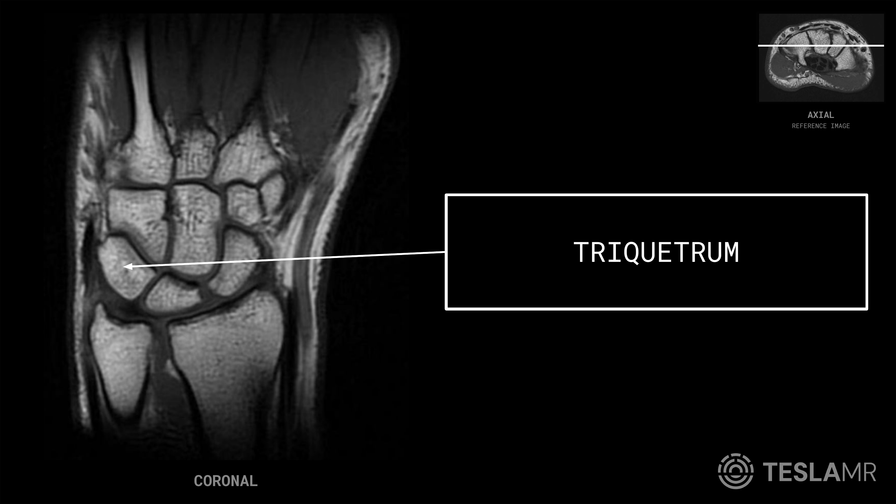Triquetrum labeled on a Wrist MRI (Coronal)