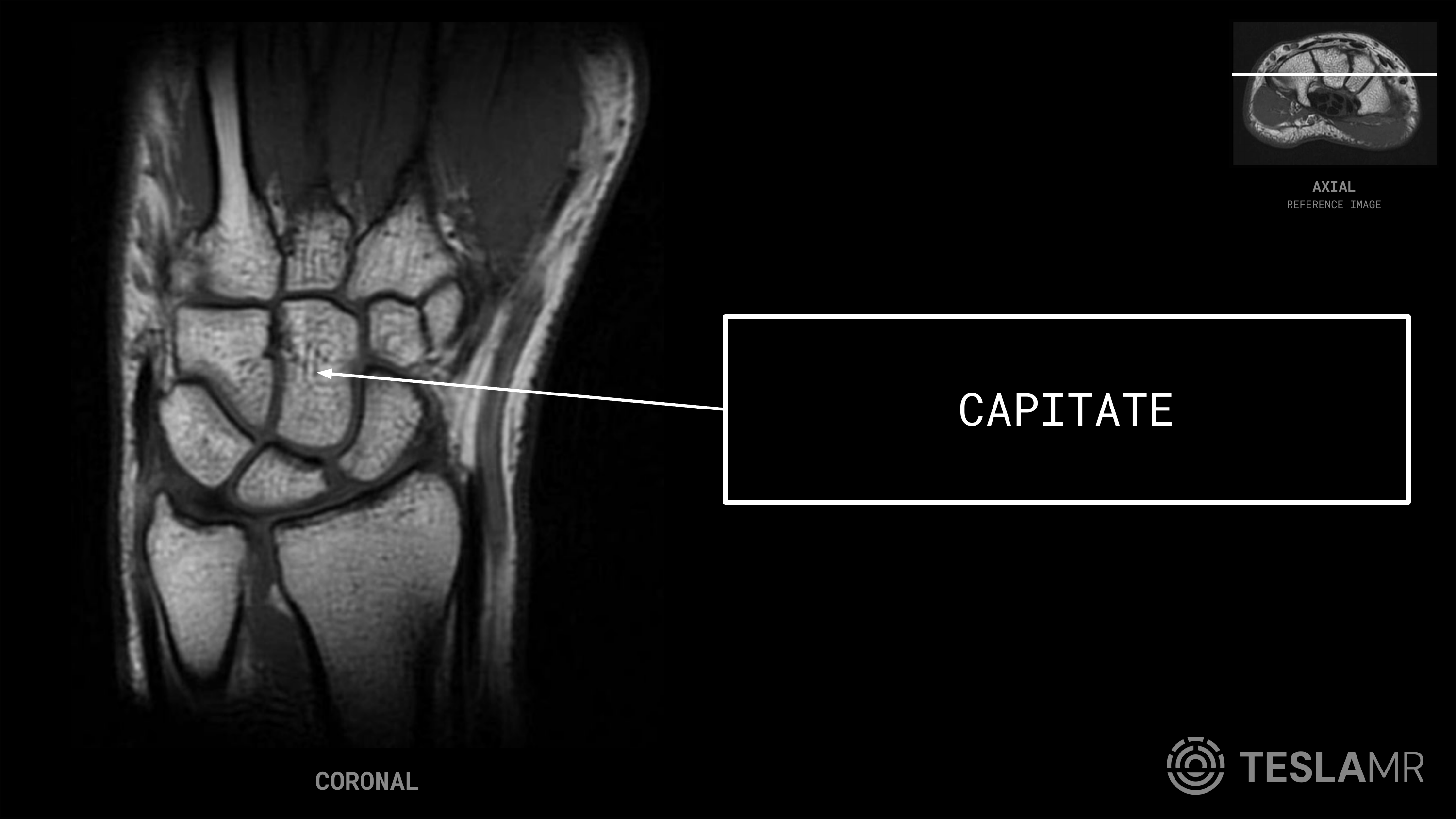 Capitate labeled on a Wrist MRI (Coronal · Axial)