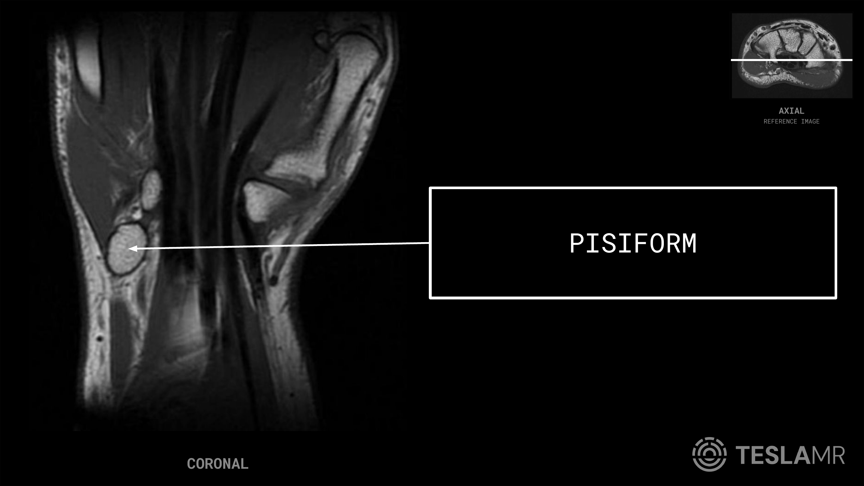 Pisiform labeled on a Wrist MRI (Coronal)