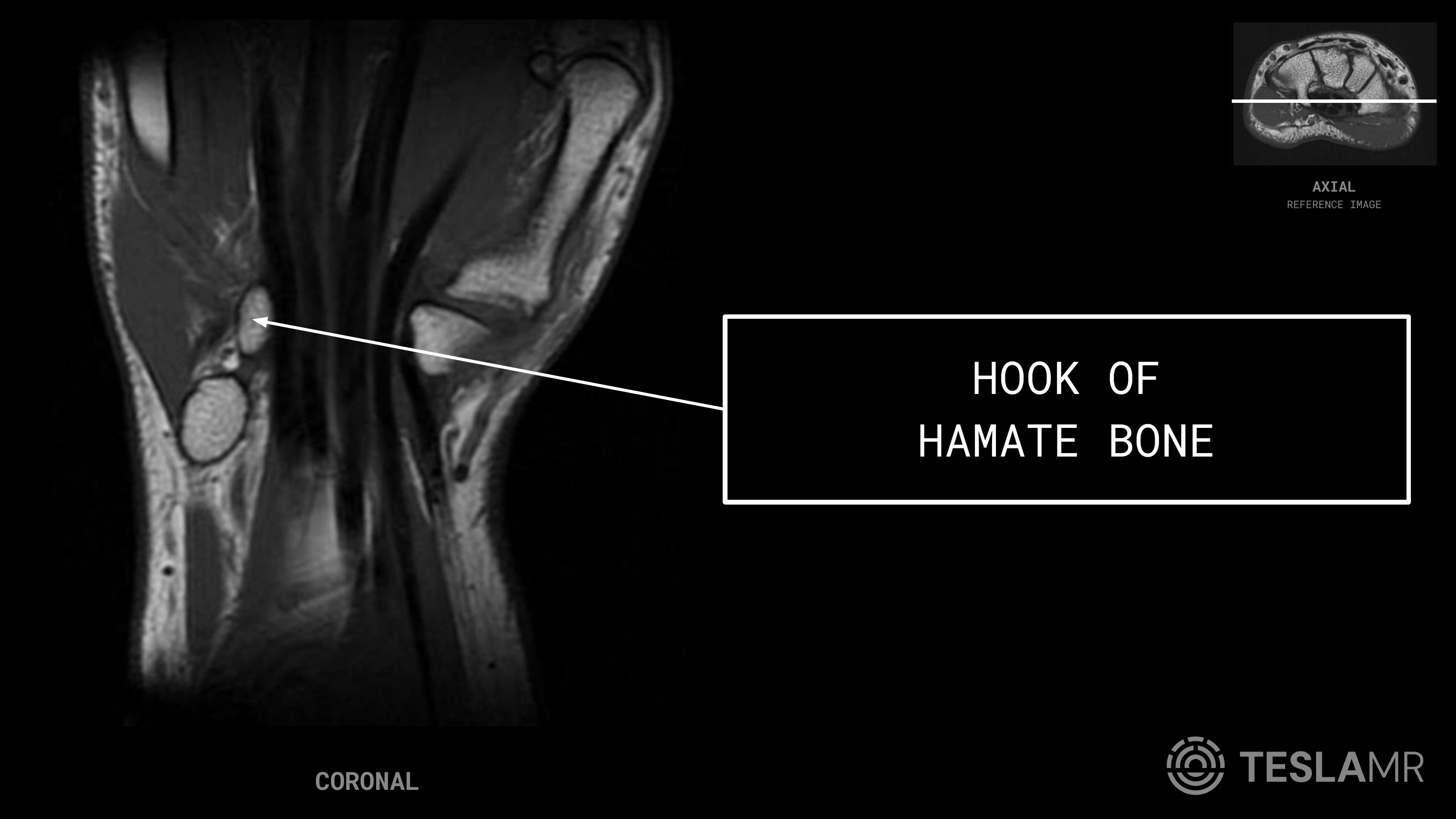 Hook of Hamate Bone labeled on a Wrist MRI (Coronal · Axial)