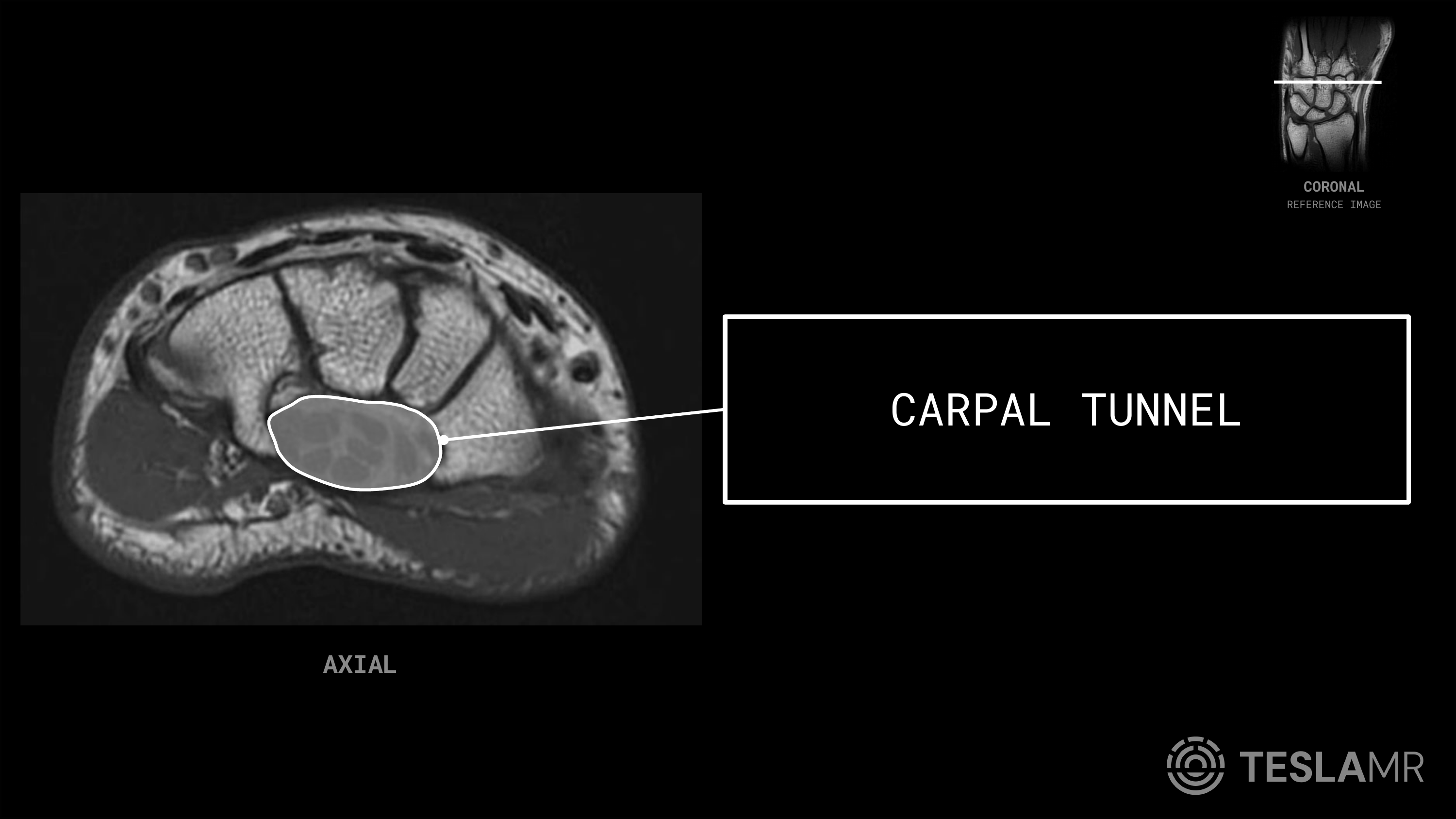 Carpal Tunnel labeled on a Wrist MRI (Axial)